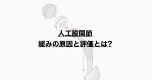人工股関節　緩みの原因と対策とは？